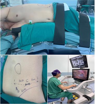 Feasibility, safety and effectiveness of robot-assisted retroperitoneal partial adrenalectomy with a new robotic surgical system: A prospective clinical study